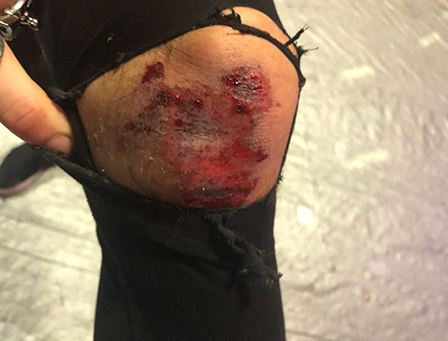 Seriously injured knee after scooter accident